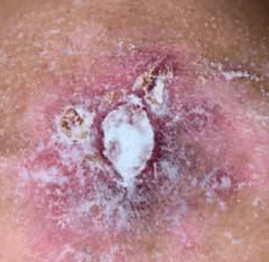 Open wound covered in a white powder.